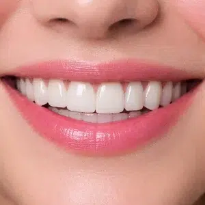 لمینیت دیجیتال کلینیک دندانپزشکی دکتر رضایی