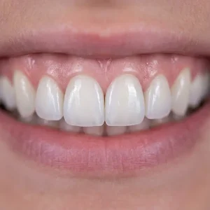 لمینیت دیجیتال کلینیک دندانپزشکی دکتر رضایی